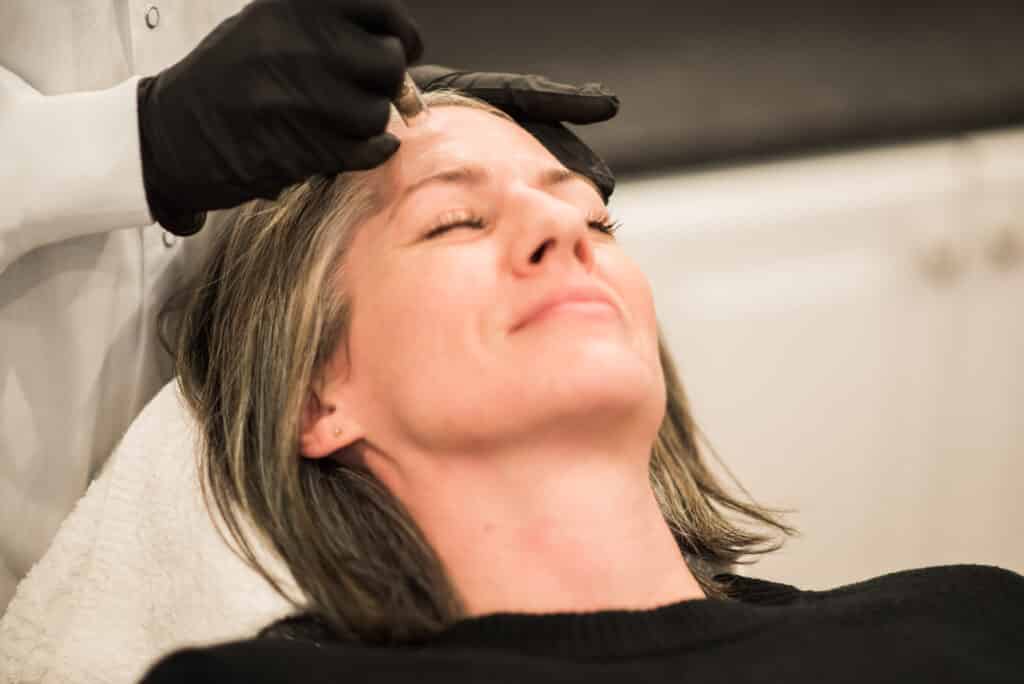 How Does Micro-Needling Work