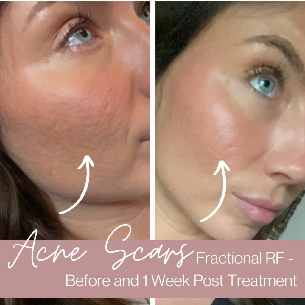 Acne scars, how to treat them with fractional RF