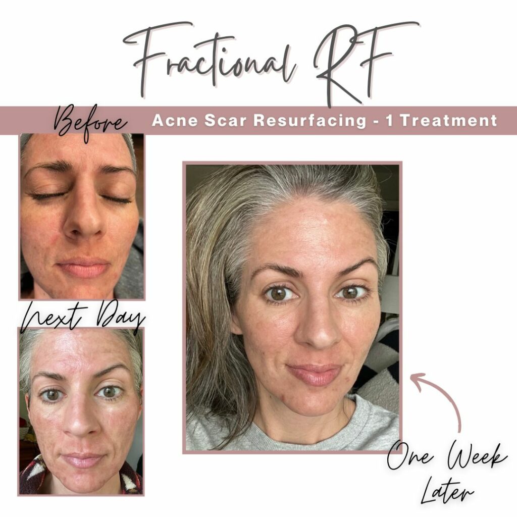 Fractional RF Acne Scar Treatment Before and After