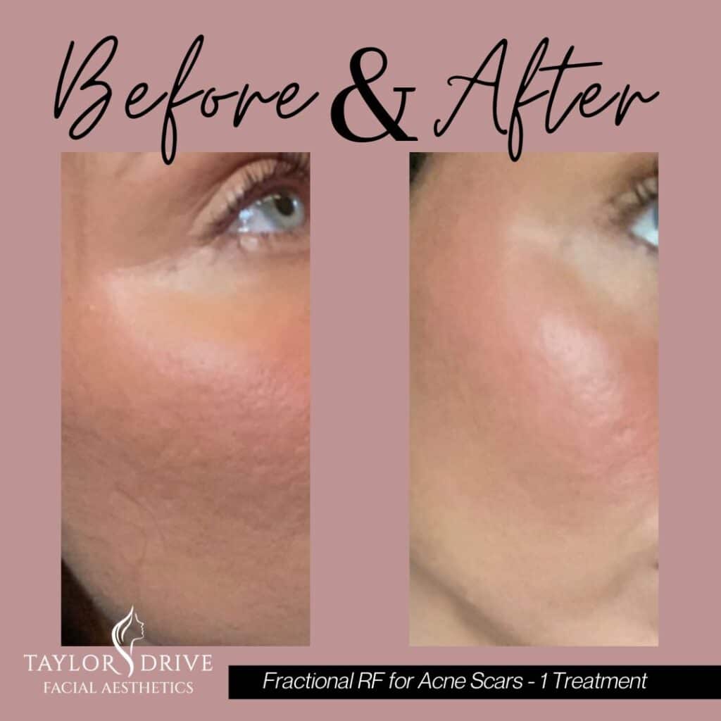 This image shows a before and after of fractional RF skin resurfacing on acne scars at Taylor Drive Facial Aesthetics in Sheboygan WI 