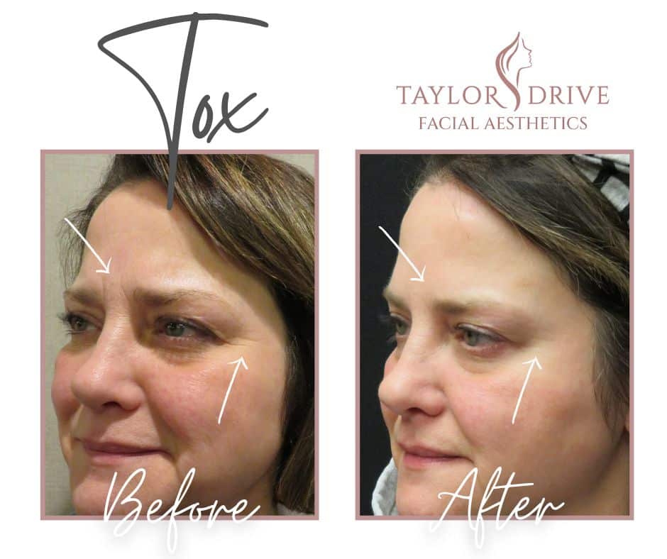 Tox, Before and After, crows feet and 11's.